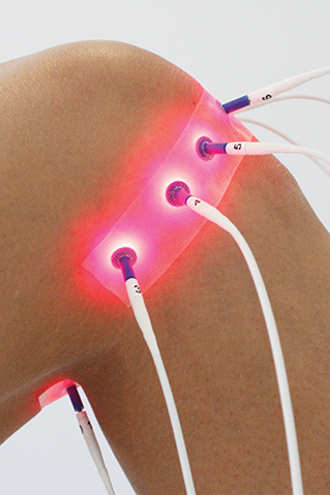 Laserakupunktur – Innovativ, effizient, schmerzfrei